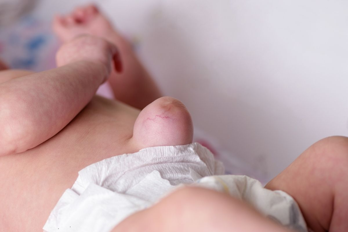 Cirugía de hernia inguinal en Tehuacán, Puebla